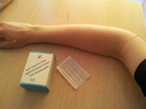 Arm mit Akupunkturnadeln